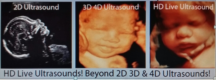 when best to get 3d ultrasound